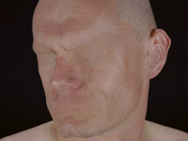 Color photograph of a bald white man with no eyes, nostrils, mouth, ear canals, or eyebrows.