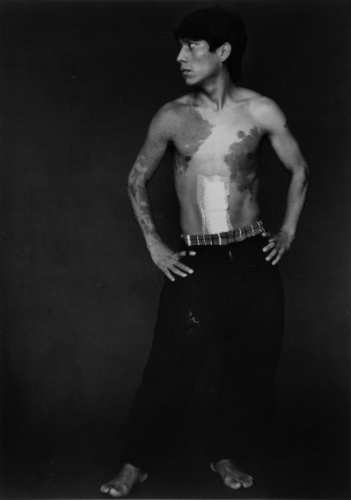 This is a black-and-white photograph of a shirtless man looking to the side with a bandage on his stomach wearing plaid boxers and dark pants with no shoes.