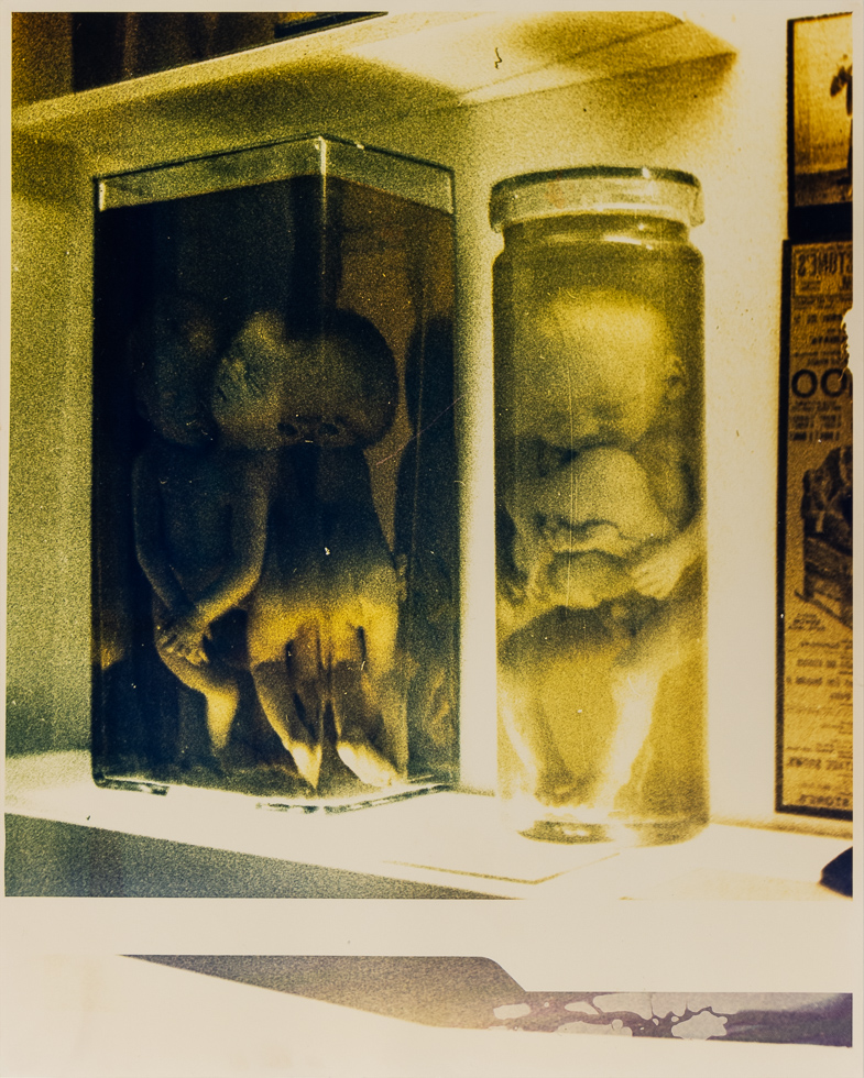 This is a yellow and green cast photograph of siamese twin fetuses in glass containers on a shelf.