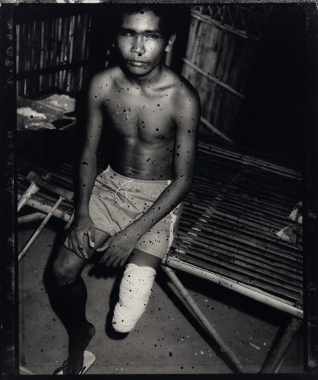 A black and white photograph of an amputee.