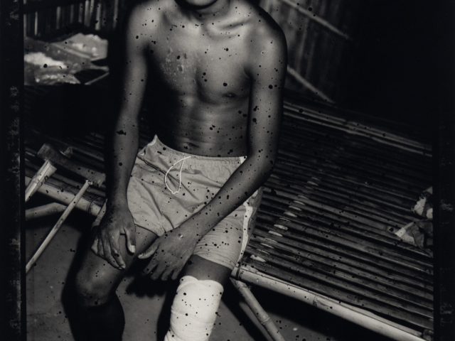 A black and white photograph of an amputee.