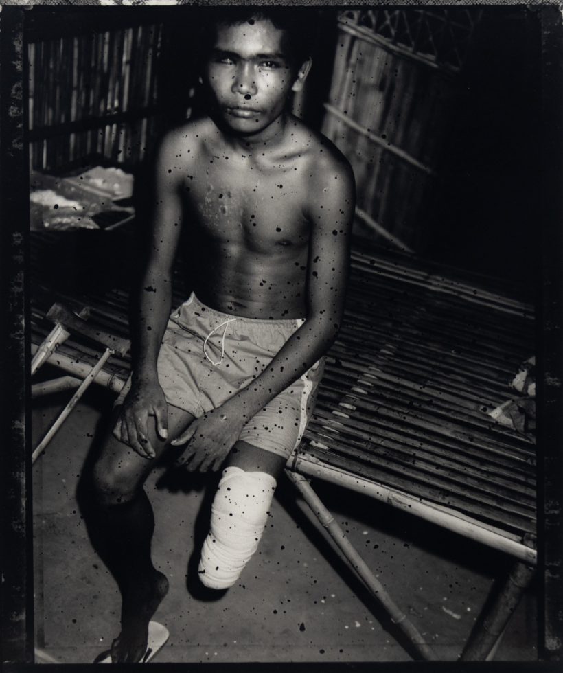 A black and white photograph of an amputee.