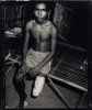 Land Mine Victim, Thai-Cambodia Border